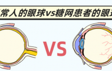老年糖尿病视网膜病变高发，怎么防治？专家来支招