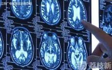 “脑子进水”不只是句玩笑话！早发现可以治愈“老年痴呆”