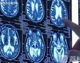 “脑子进水”不只是句玩笑话！早发现可以治愈“老年痴呆”