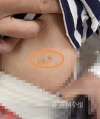诡异操作！柳州女子到养生馆按摩，被蒙眼植入不知名东西